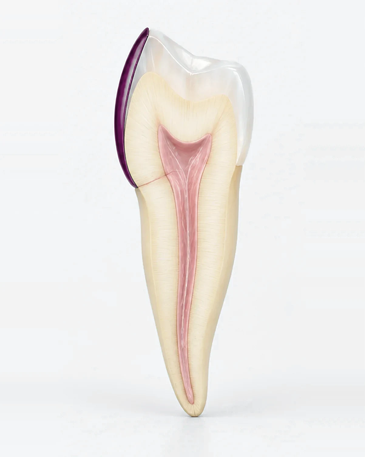 Lo stesso dente con una faccetta in ceramica sul davanti